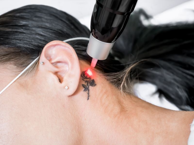 remoção de tatuagem cuiaba