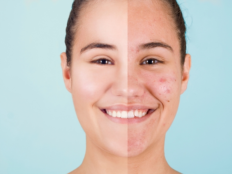 duoglide antes e depois_