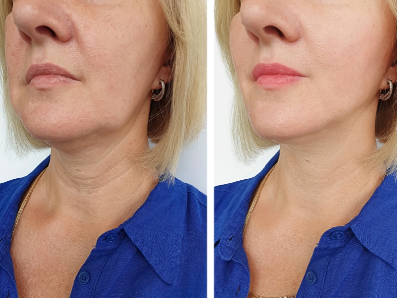 virtue rf antes e depois_