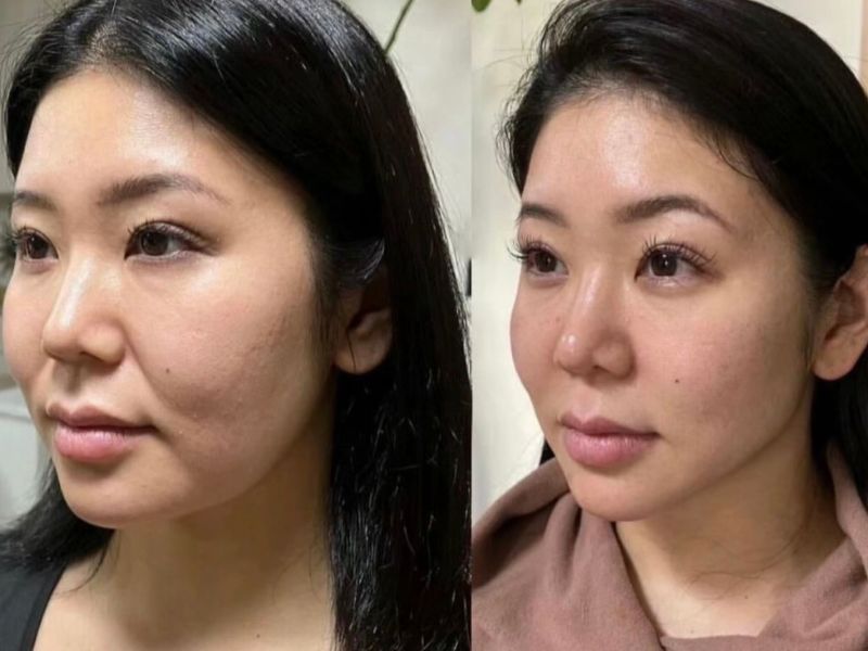 antes e depois dos fios de colágeno