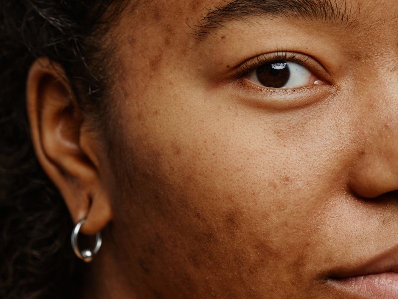como clarear melasma - tratamentos