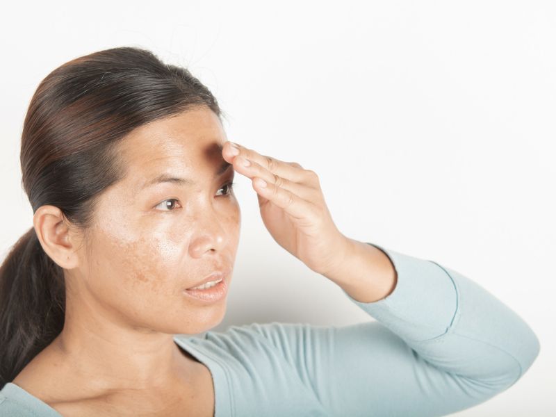 como clarear melasma - proteção