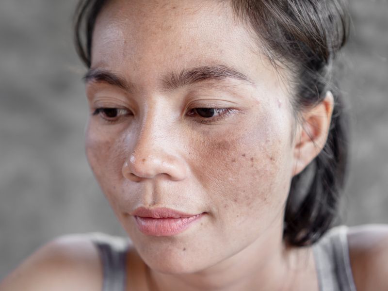 como clarear melasma - procedimentos