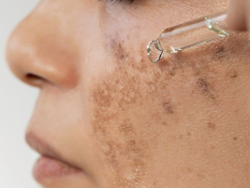 qual o melhor tratamento para melasma - opções