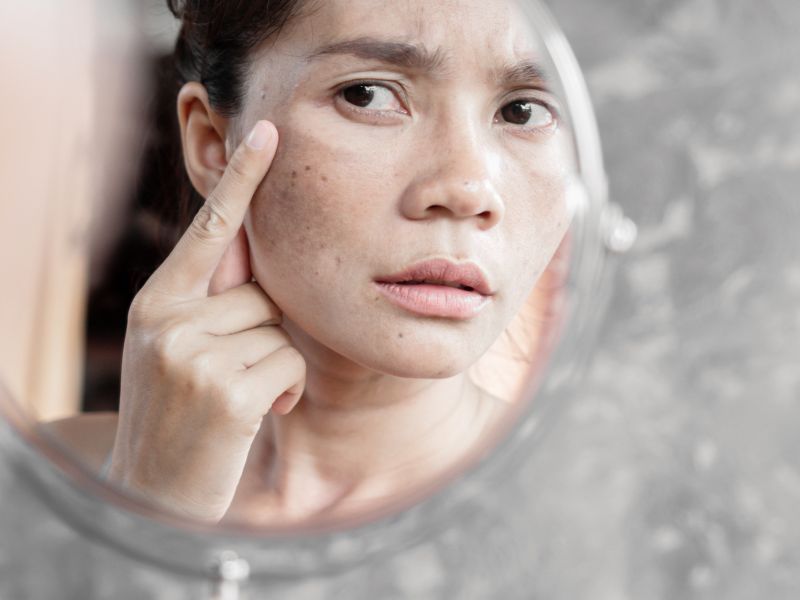 qual o melhor tratamento para melasma