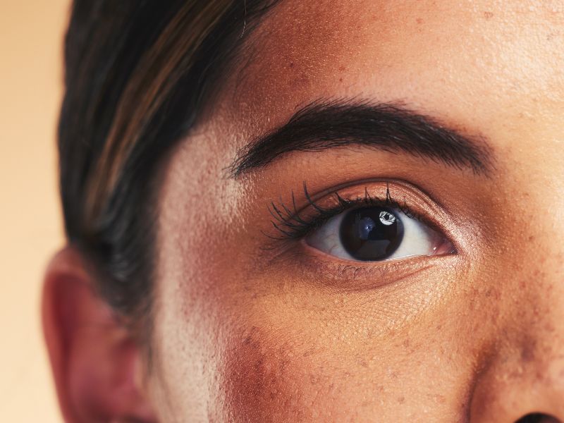 como saber se tenho melasma - caracteriza