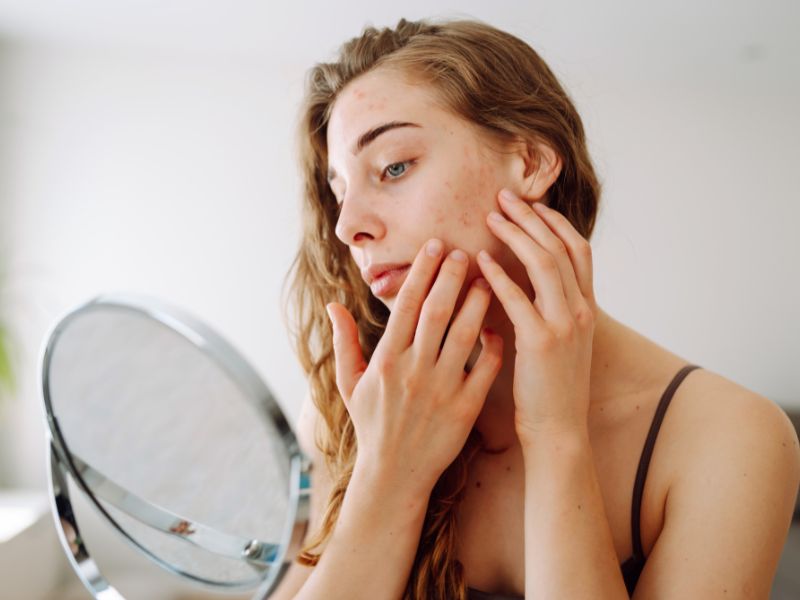 como saber se tenho melasma