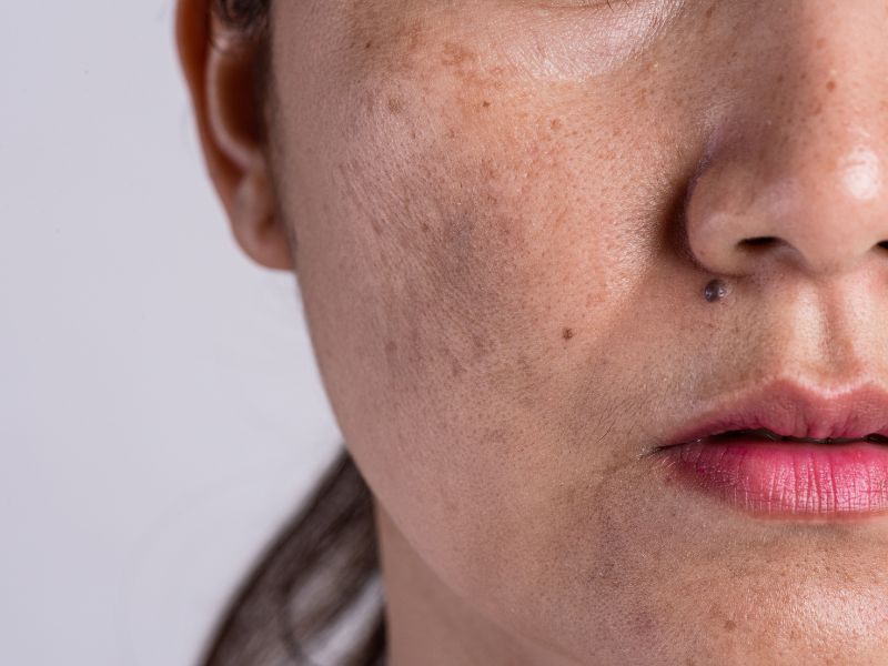 como saber se tenho melasma - caracteriza